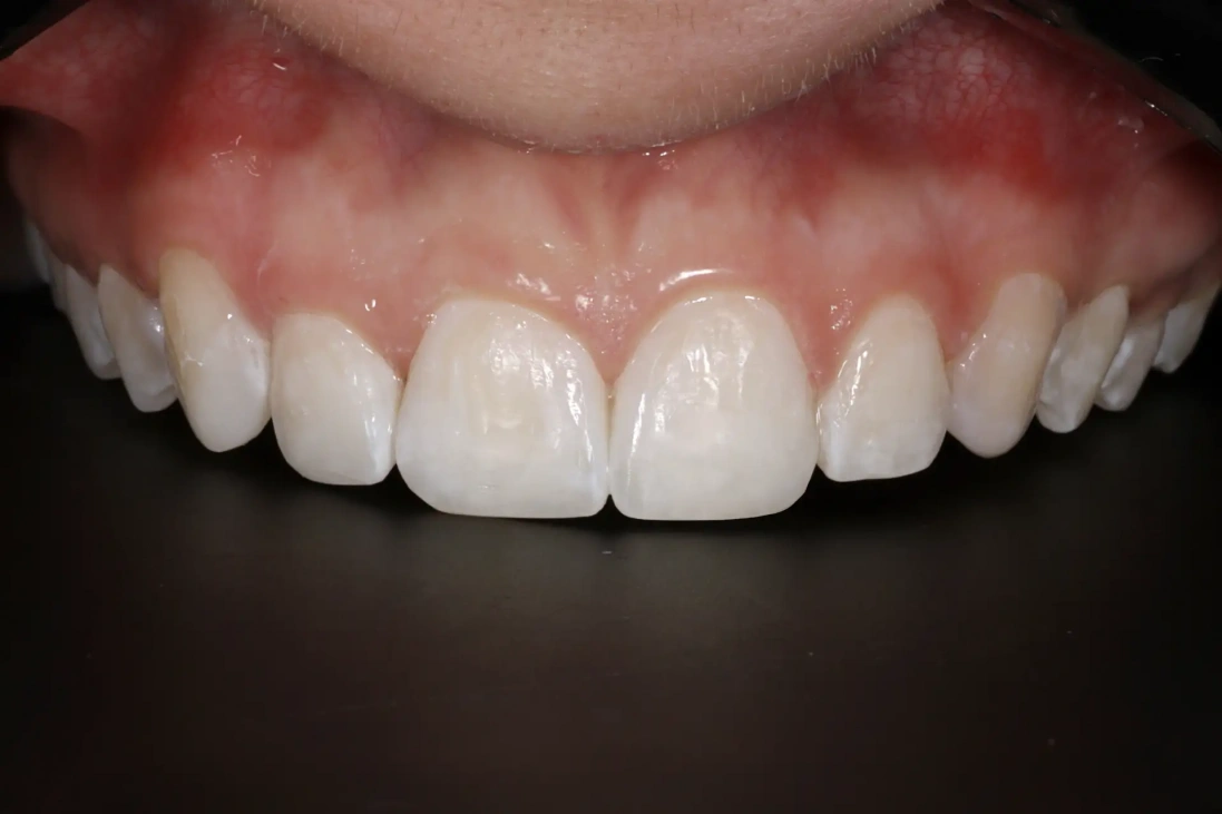  8compositebonding-after