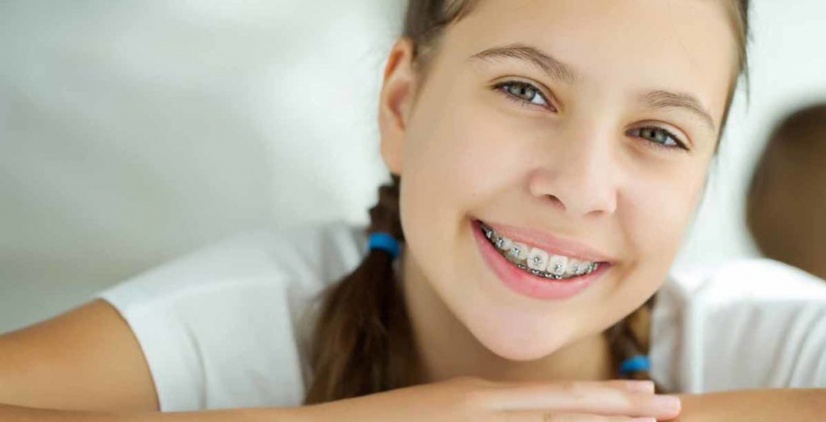 Images Blog First Ortho Exam Ceramic-braces-for-kids-teens-Newcastle-Sydney
