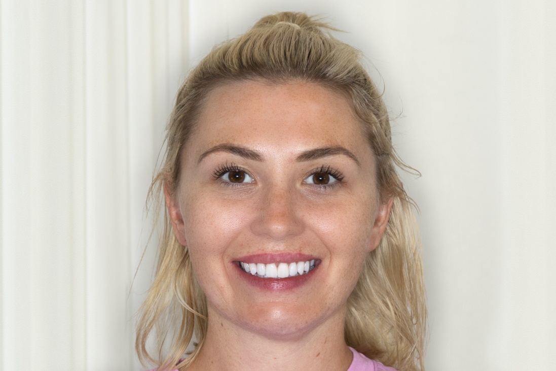  New Images Porcelain Veneers porcelain-veneers-newcastle-before-and-after-profilo-dental-8